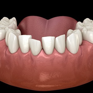 Illustration of crooked teeth