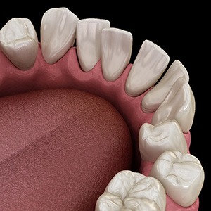 Illustration of gapped teeth