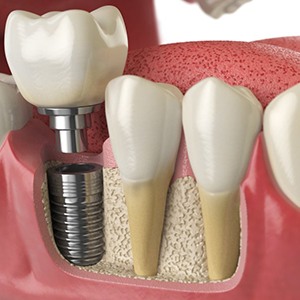 diagram of a dental implant in Bettendorf