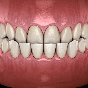 Illustration of an underbite