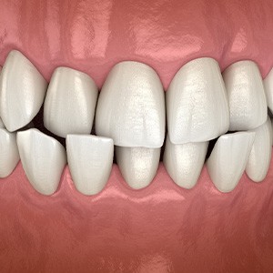 Illustration of a crossbite