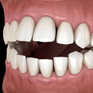 Illustration of an open bite