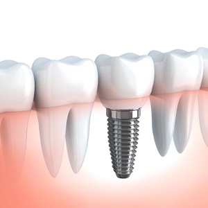 Illustration of dental implant along with natural teeth