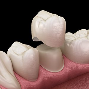 A 3D illustration of a CEREC same-day dental crown