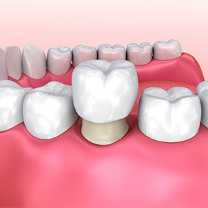 Dental crown image