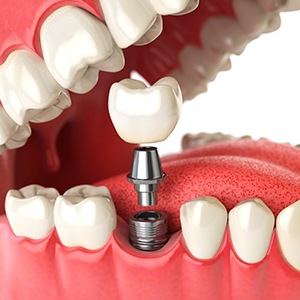 illustration dental implant being placed in the lower jaw