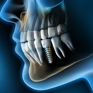 X-ray of a patient with a dental implant