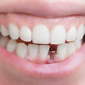 close-up of a mouth with a dental implant