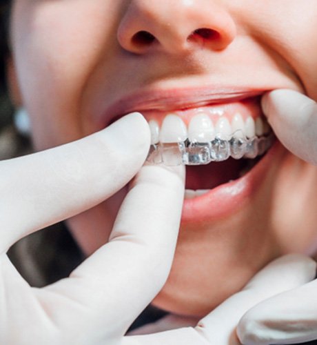 Dentist placing clear aligner on patient's top teeth