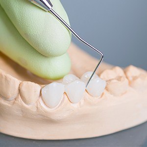 Model smile with dental bridge restoration