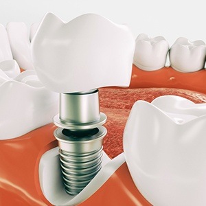 Animation of dental implant placement