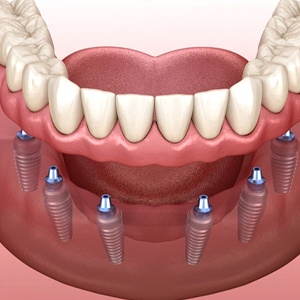 implant-retained dentures 