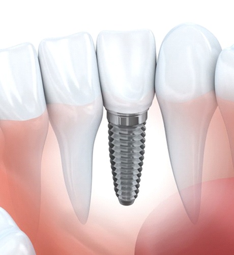 A diagram of a dental implant.