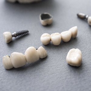 A series of dental restorations.