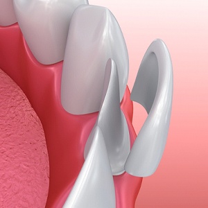 Dental veneer in front of tooth