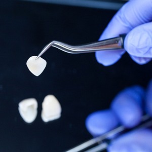 Veneers in dental lab