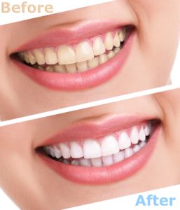 Cosmetic dentist before and after teeth whitening.