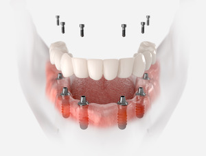 Illustration of an implant denture for the lower arch