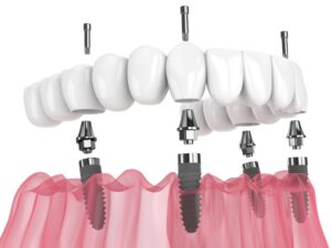 Animated model of All-on-4 implants.